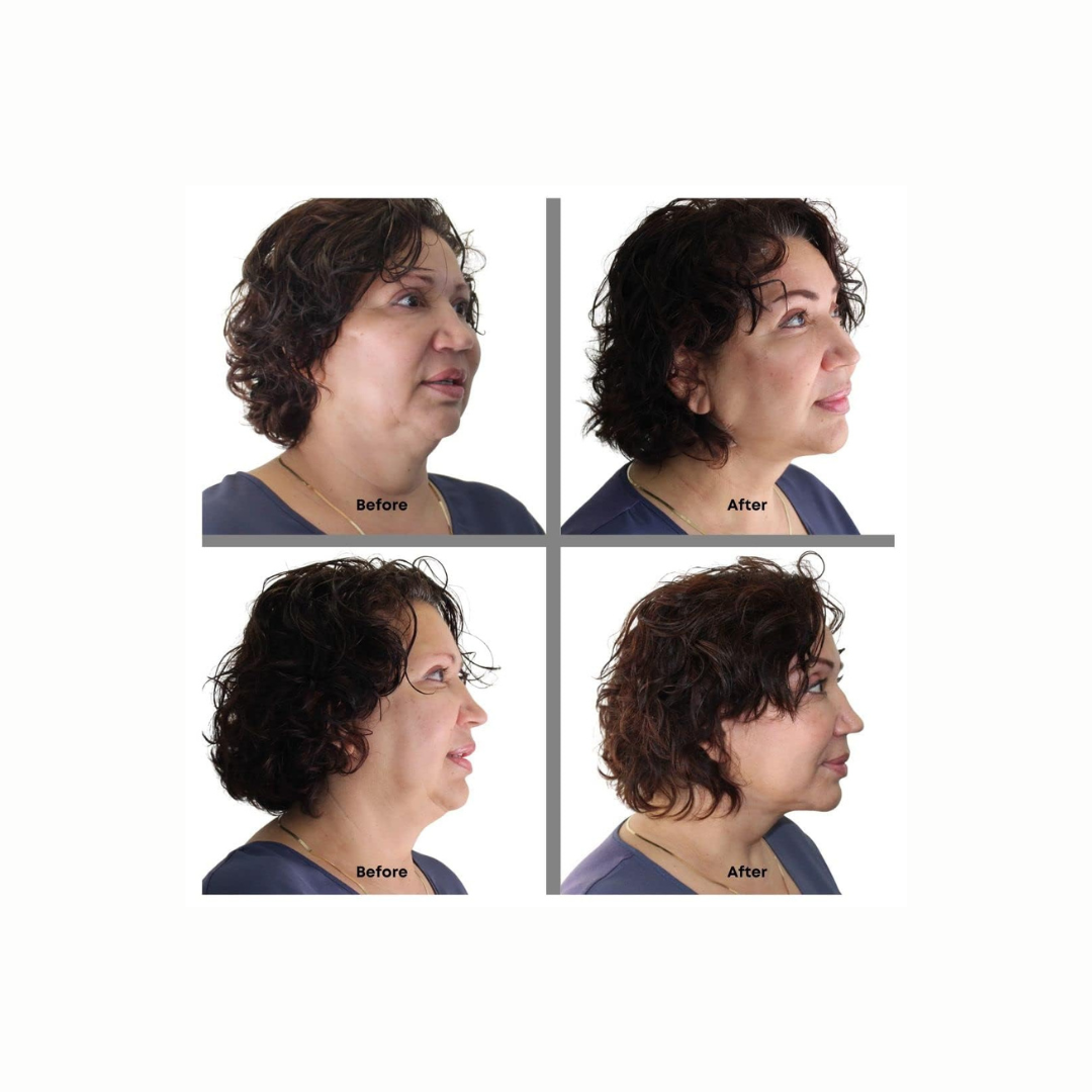 Bring It Up Instant Neck Lift Tape 30 Day Supply, Transparent Neck Lifting Anti Wrinkle Stickers