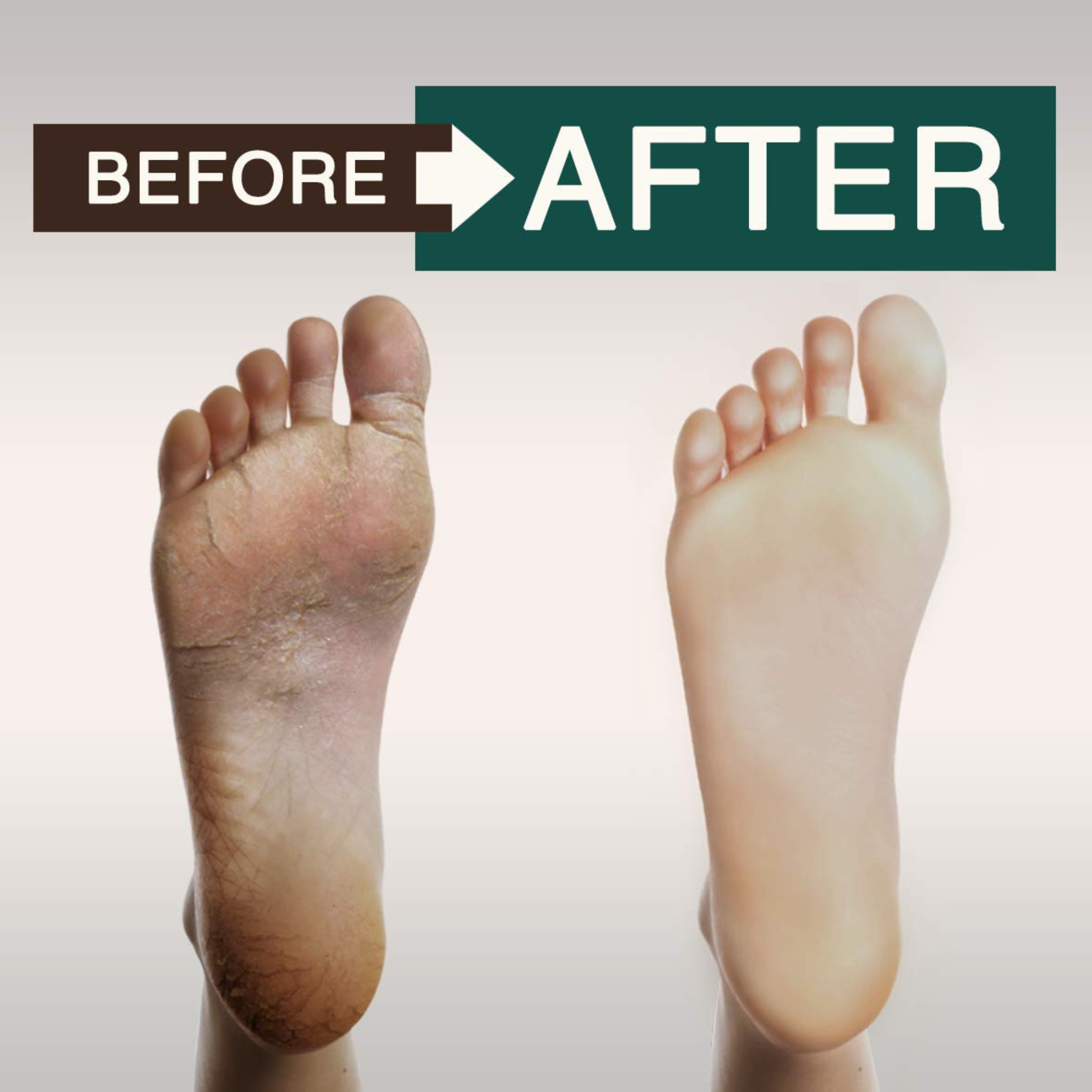 Tea Tree Oil Body Wash - Antifungal - Antibacterial Soap-Helps Athletes Foot - Toenail Fungus - Ringworm - Jock Itchy - Acne - Eczema - Yeast Infection - Body Odor - Itchy Skin - Sulfate Free - 16oz